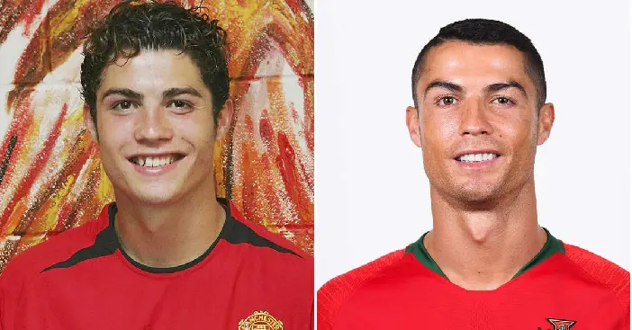 Ronaldo's smile 'before' in 2004 compared to his smile in 2018 'after' having teeth whitening. His smile after the procedures changed his looks too