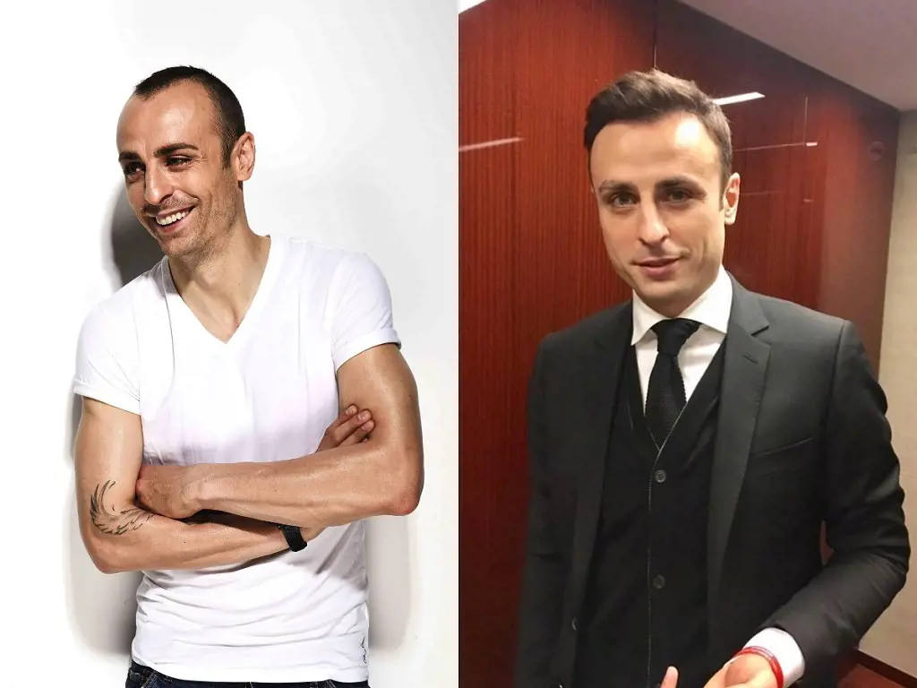 Dimitar Berbatov before and after hair restoration photos