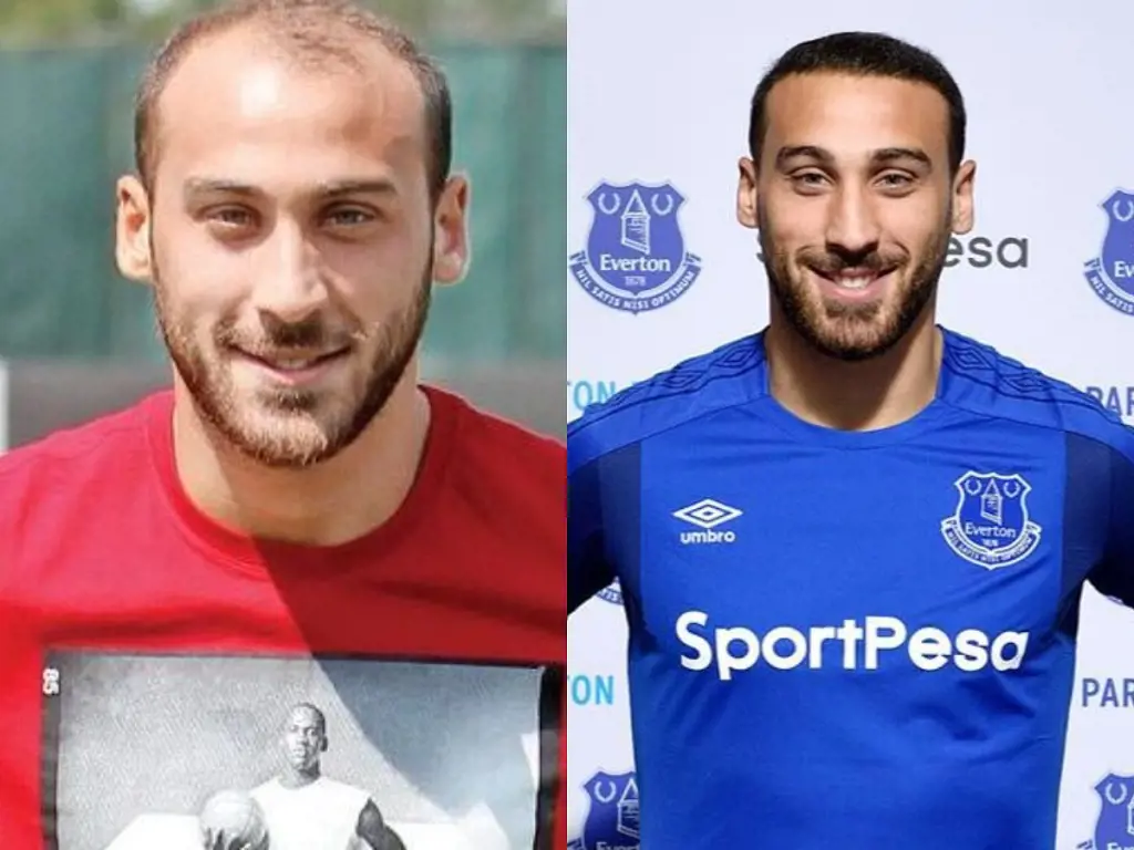 Turkish forward Cenk Tosun photos before and after.