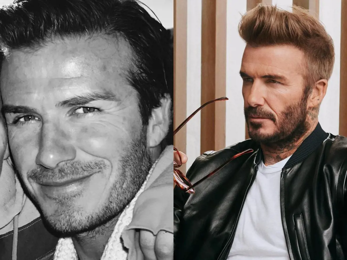 David Beckham's temples, shown in the left shot receding and the right one growing back, can be seen in comparison photos before and after
