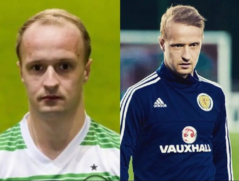 The above two pictures show Leigh Griffiths' hairline before and after the surgery