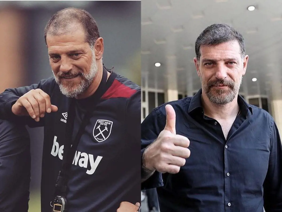 Slavn Bilic before and after photos of when he had the procedure while still being a manager of West Ham United.