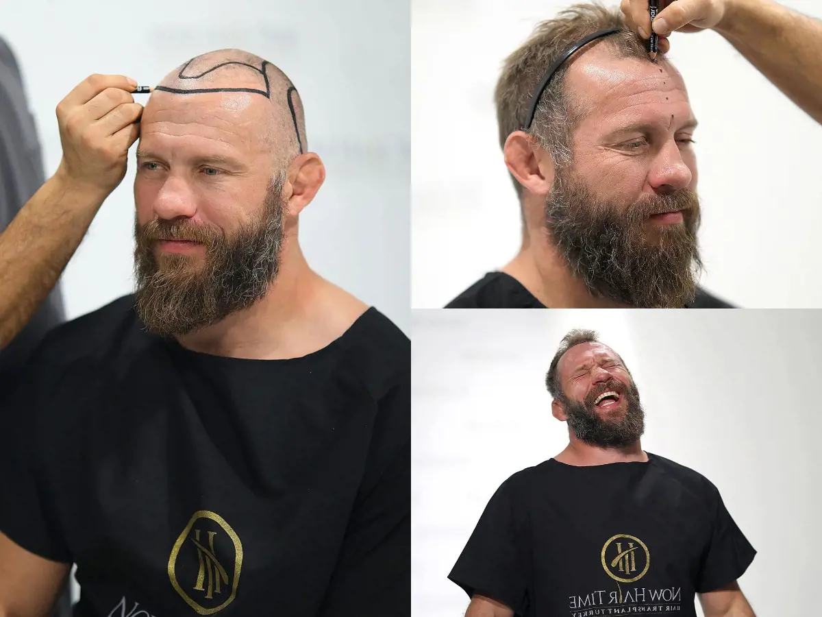 Cerrone in laugh while he gets his hair surgery at Now Hair Time in Turkey